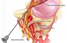 Cervical transforaminal needle vascular risk