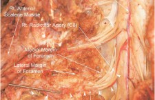 Cervical radicular artery (cadaver)
