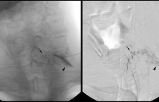 Cervical transforaminal with digital subtraction