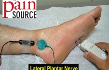 Lateral Plantar Nerve NCS Setup