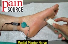 Medial Plantar Nerve NCS Setup