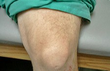 Prepatellar Bursa Aspiration and Injection