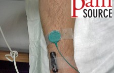 Radial Motor NCS Setup – elbow