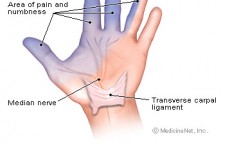 Carpal Tunnel Syndrome