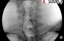 Cervical contralateral oblique epidural pics – 01 – The Pain Source