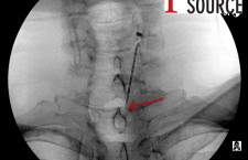 Cervical contralateral oblique epidural pics – 02 – The Pain Source