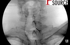 Cervical contralateral oblique epidural pics – 03 – The Pain Source