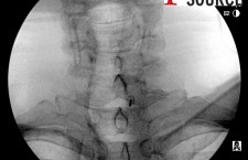 Cervical contralateral oblique epidural pics – 04 – The Pain Source