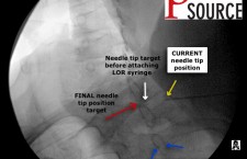 Cervical contralateral oblique epidural pics – 05 – The Pain Source