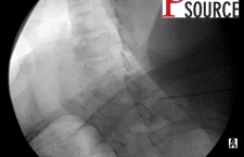 Cervical contralateral oblique epidural pics – 06 – The Pain Source