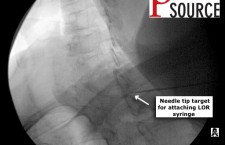 Cervical contralateral oblique epidural pics – 09 – The Pain Source