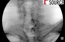 Cervical contralateral oblique epidural pics – 10 – The Pain Source