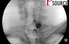 Cervical contralateral oblique epidural pics – 11 – The Pain Source