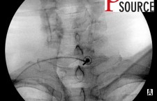 Cervical contralateral oblique epidural pics – 12 – The Pain Source