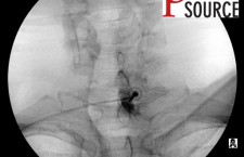 Cervical contralateral oblique epidural pics – 13 – The Pain Source