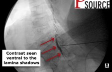 Cervical contralateral oblique epidural pics – 14 – The Pain Source