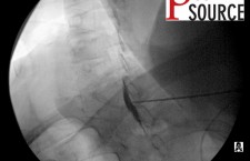 Cervical contralateral oblique epidural pics – 15 – The Pain Source