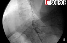 Cervical contralateral oblique epidural pics – 16 – The Pain Source