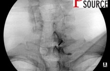 Cervical contralateral oblique epidural pics – 17 – The Pain Source