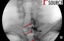 Cervical contralateral oblique epidural pics – 18 – The Pain Source