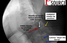 Contralateral Oblique View -Labeled – The Pain Source