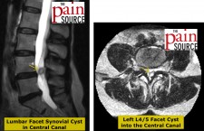 Large LEFT L4-L5 synovial facet cyst on T2-weighted MRI – sagittal and axial views