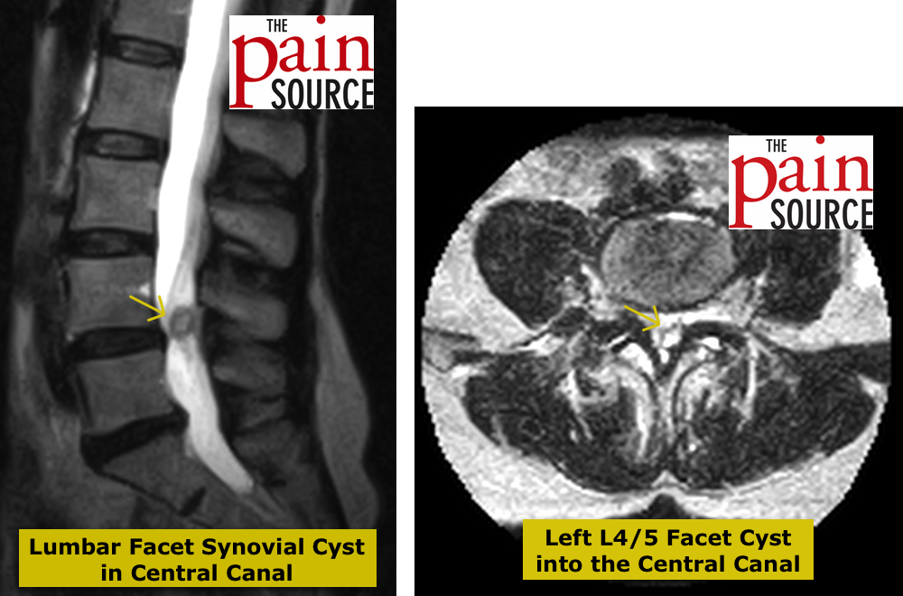 synovial cyst spine