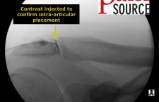 Acromioclavicular joint injection with fluoroscopy – Contrast confirms intraarticular spread – The Pain Source