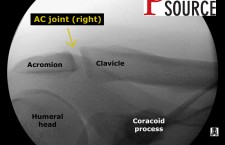 Acromioclavicular joint injection with fluoroscopy – Labeled AP xray – The Pain Source