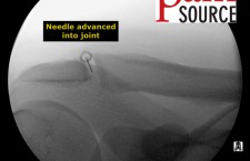 Acromioclavicular joint injection with fluoroscopy – Needle advanced into joint – The Pain Source