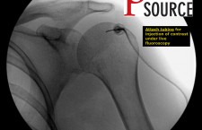 Glenohumeral joint injection with fluoroscopy – Attach tubing – The Pain Source