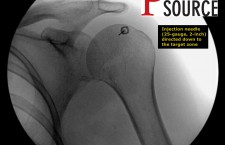 Glenohumeral joint injection with fluoroscopy – Needle down to target zone – The Pain Source