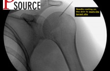 Glenohumeral joint injection with fluoroscopy – Needle on skin – The Pain Source