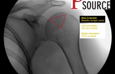 Glenohumeral joint injection with fluoroscopy – labeled starting image – The Pain Source