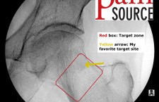 Hip Injection with fluoroscopy – Scout view – Labeled – ThePainSource