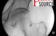 Hip Injection with fluoroscopy – Step 01 – ThePainSource