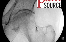 Hip Injection with fluoroscopy – Step 02 – ThePainSource