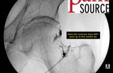 Hip Injection with fluoroscopy – Step 03 – ThePainSource