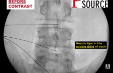 Lumbar Discogram – AP view. Before contrast – The Pain Source