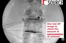 Lumbar Discogram – AP view. Extravasation of contrast – The Pain Source