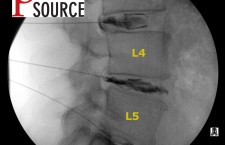 Lumbar Discogram – Lateral view. After contrast – The Pain Source