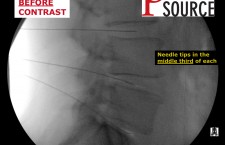 Lumbar Discogram – Lateral view. Before contrast – The Pain Source