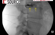 Lumbar Discogram – Lateral view. L3-L4 contrast – The Pain Source