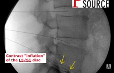 Lumbar Discogram – Lateral view. L5-S1 contrast – The Pain Source