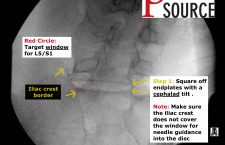 Lumbar Discogram – Oblique view for left approach of L5-S1 disc – The Pain Source