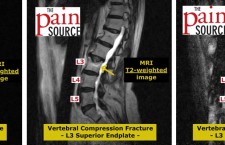 L3 superior endplate compression fracture – T1, T2, and STIR images – The Pain Source