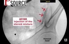 Sacroiliac joint injection with fluoroscopy – After injection of the steroid mixture – The Pain Source