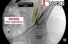 Sacroiliac joint injection with fluoroscopy – BEFORE injection – The Pain Source