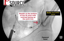 Sacroiliac joint injection with fluoroscopy – Contrast going up the joint line – The Pain Source