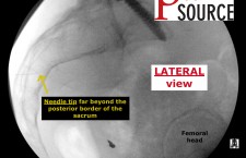 Sacroiliac joint injection with fluoroscopy – Lateral view before the injection – The Pain Source